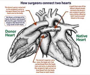 Piggyback Heart Transplant Procedure in Chennai  Interview With Dr.Ejaz Ahmed Sheriff