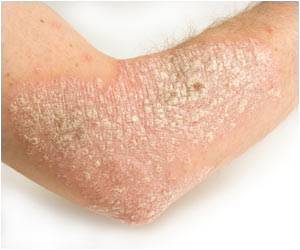 Promising New Target for Treatment of Psoriasis is Safe