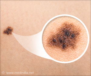 Reactivating Bodys Defenses Can Stop Skin Cancer Growth