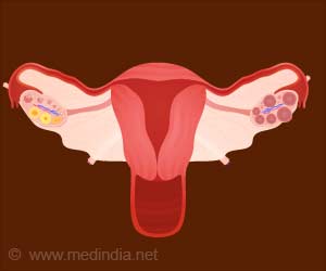 What Causes Diabetes in Women With Polycystic Ovarian Syndrome?