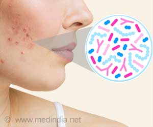 Can Skin Probiotic Treat Acne?