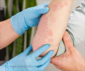Skin Rashes Indicate the Onset of COVID-19
