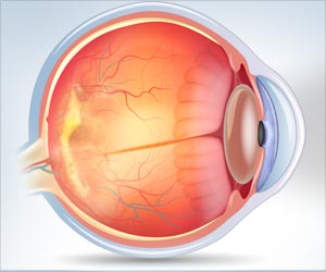 Stem Cell Therapy to Treat Dry Macular Degeneration