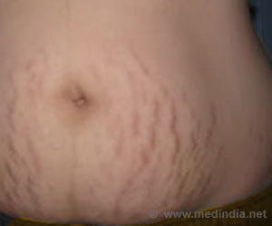 stretch marks rid easy steps weight mark remedies medindia mommy recently lost