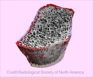 Teenage Obesity Permanently Affects Bone Health