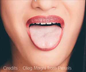 Tongue Microbiome Could Help Early Detection of Pancreatic Cancer