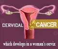 Cervical Cancer