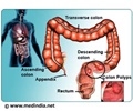 Colon Polyps