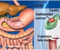 Gallbladder Cancer