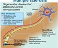 Multiple Sclerosis - New Drug