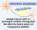 Multiple Sclerosis