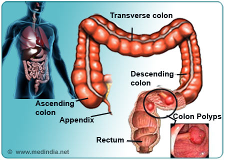 Colon Polyps