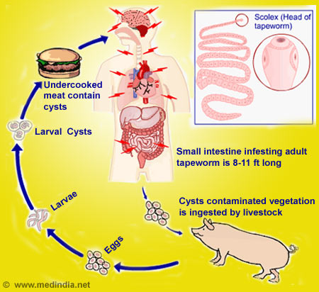 Neurocysticercosis