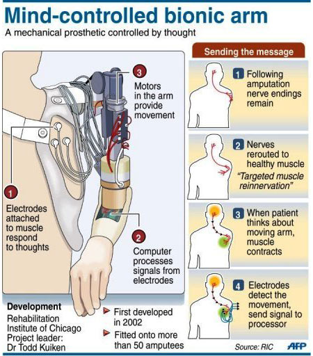 Infographic On Prosthetic Limbs 