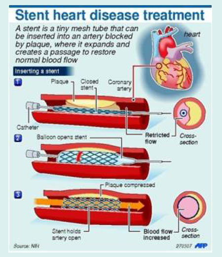 Coronary Stents