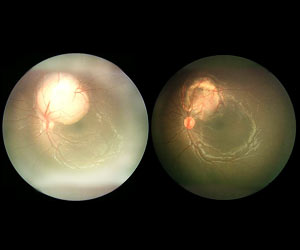 Intraocular Retinoblastoma