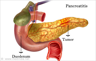 Indigestion - Symptom Evaluation - Condition, Diagnosis, Treatment, FAQs