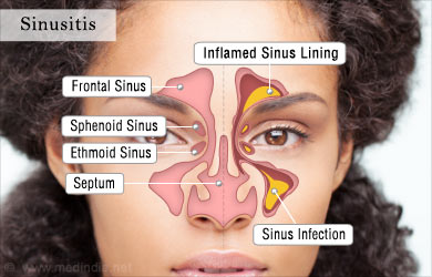 Nasal Pain - Symptom Evaluation