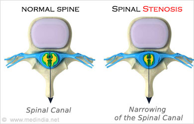 Spinal Injury - Symptom Evaluation