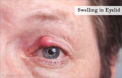 Symptom Evaluation of Watery Eyes