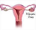 Polycystic Ovarian Syndrome