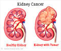 Kidney Cancer