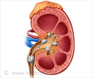 Home Remedies for Kidney Stones