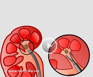 Retrograde Intrarenal Surgery (RIRS) 