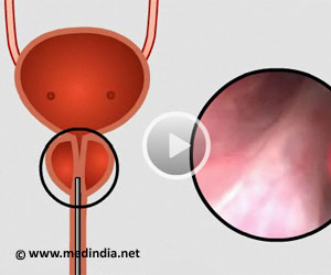Transurethral Resection Of Prostate Turp For Patient Education Health Video Medindia