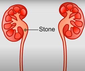 Urethral Calculus