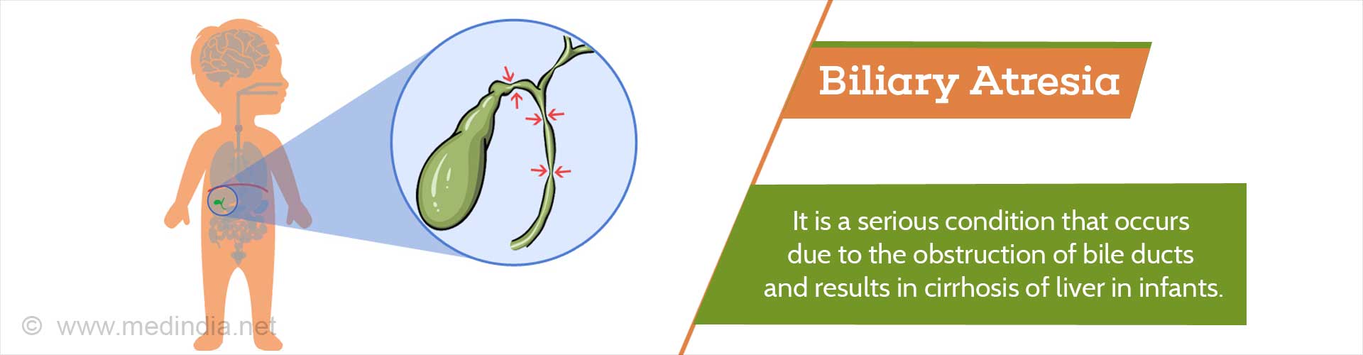 Biliary Atresia - Types, Causes, Symptoms, Diagnosis, Treatment ...