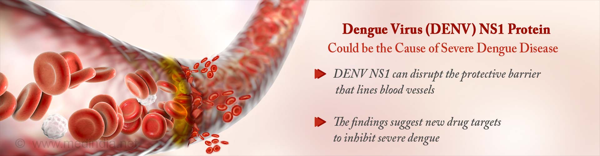 DENV NS1 protein could cause vascular leakage in severe dengue