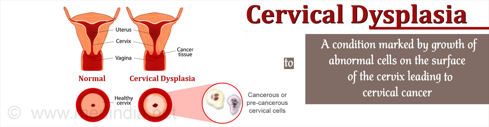 Cervical Dysplasia Causes Symptoms Diagnosis Treatment Prevention