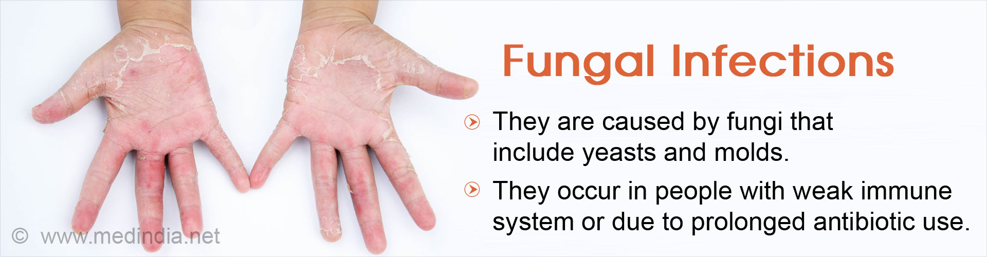 Fungal Infections Causes, Symptoms, Diagnosis, Treatment & Prevention