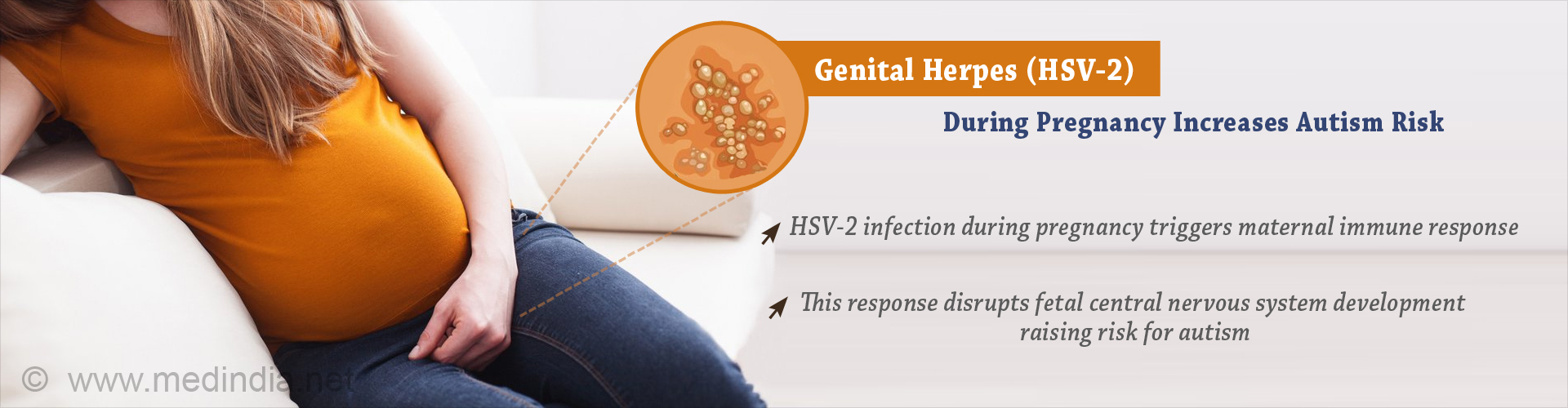 herpes-infection-during-pregnancy-increases-risk-of-autism-in-children