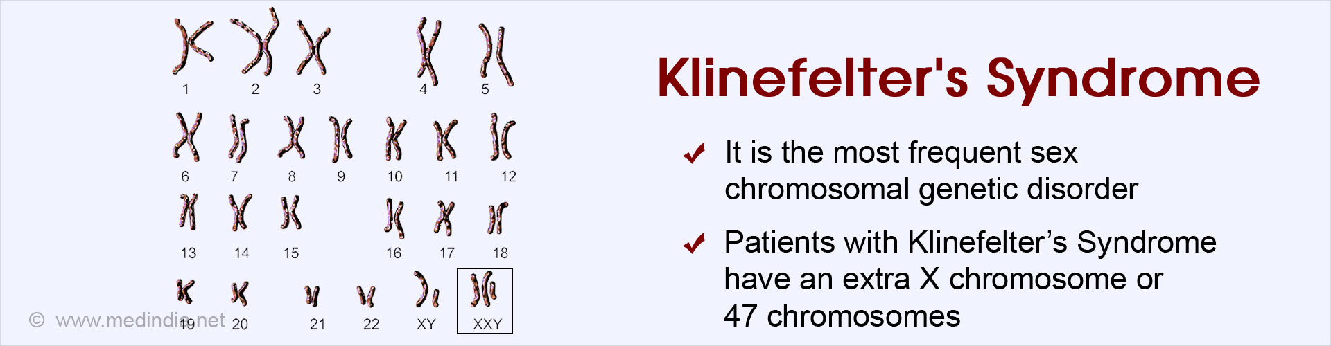 Klinefelter S Syndrome Causes Symptoms Diagnosis Treatment And Complications