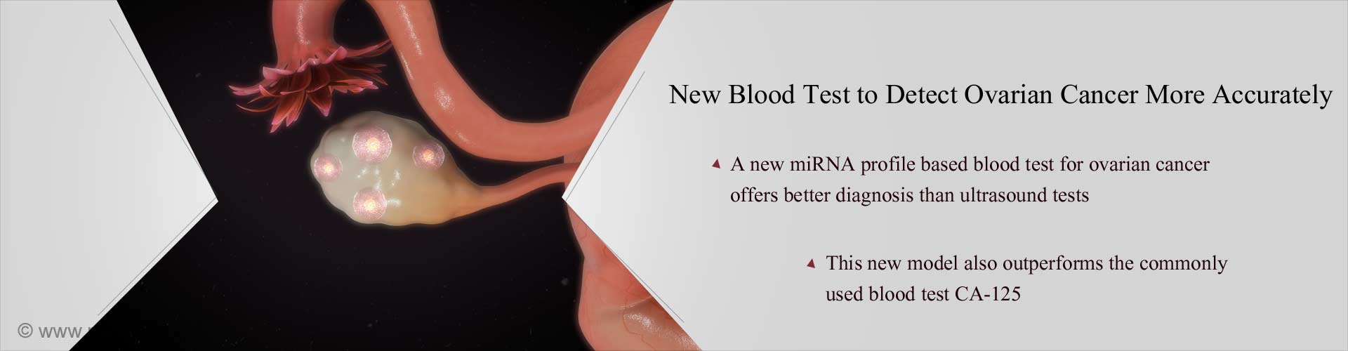 Can A Blood Test Diagnose Ovarian Cancer