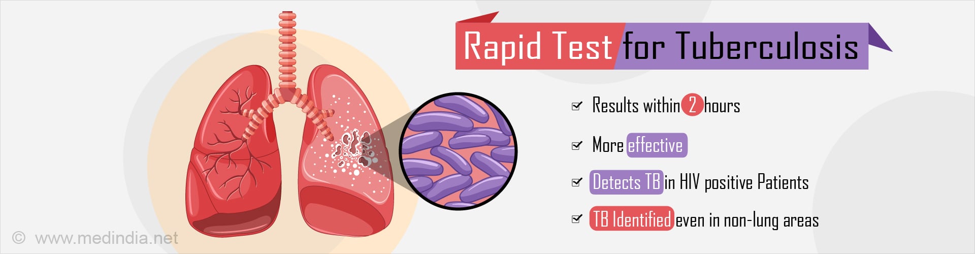 New Rapid Diagnosis Test To Identify Tuberculosis Early