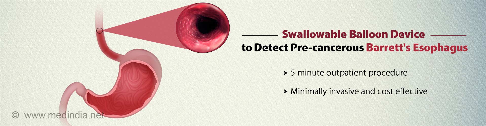 Simple, Swallowable Test for Early Detection of Barrett's Esophagus