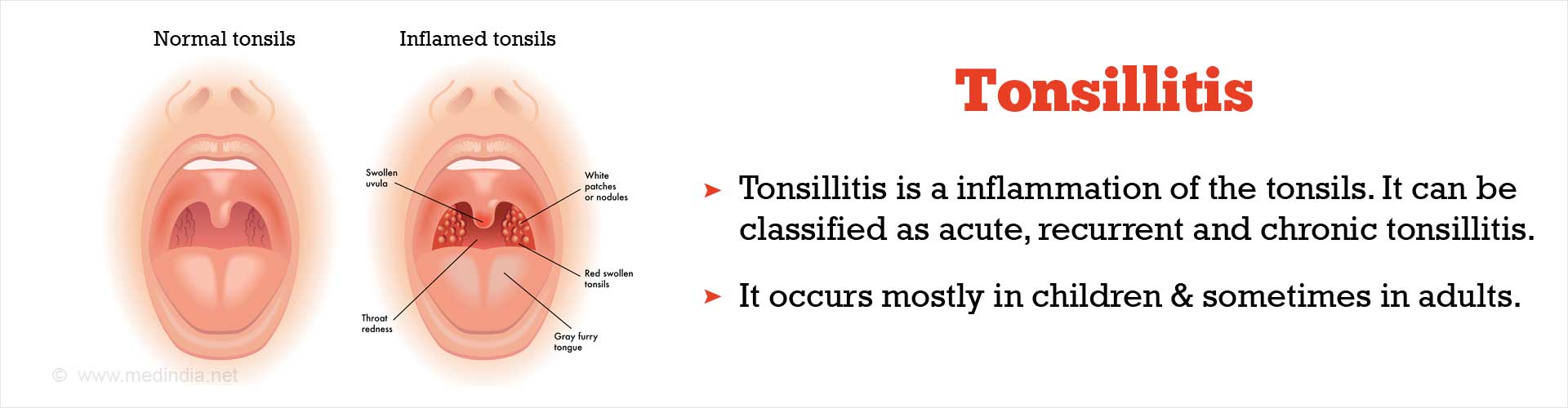 Tonsillitis - Types, Causes, Symptoms, Complications, Diagnosis