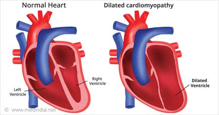 New Treatment Option Identified for Serious Heart Condition - Health Tips