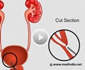 Ureteric False Passage