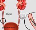 Ureteric Stone Fragmentation