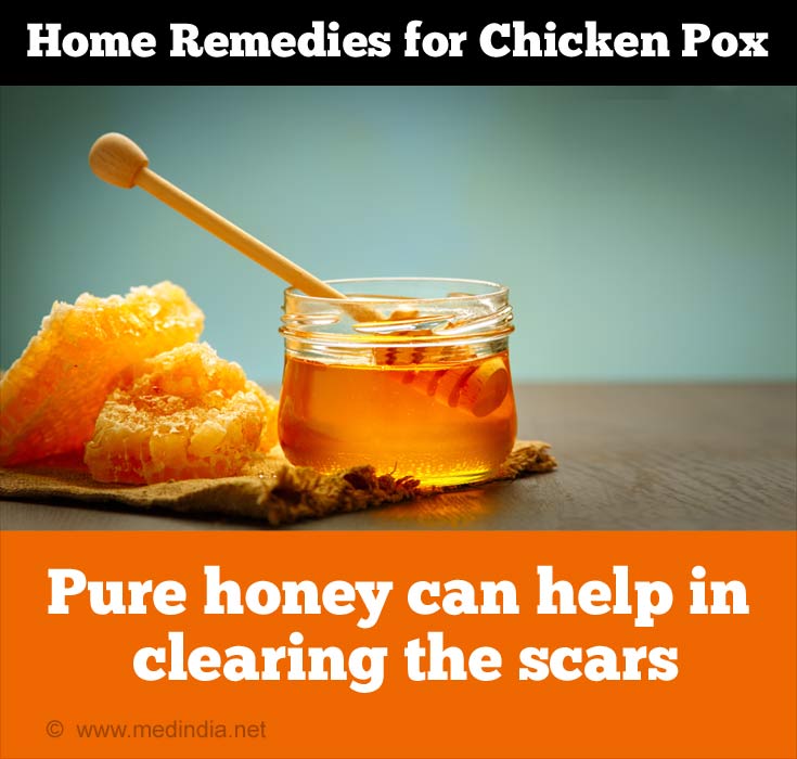 Home Remedies For Chicken Pox