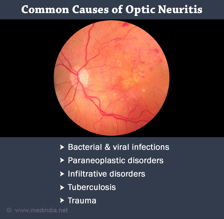 home-remedies-for-optic-neuritis