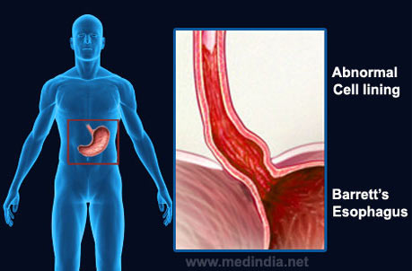 Barrett’s Esophagus - Infographic