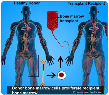 Bone Marrow Transplantation - Infographic