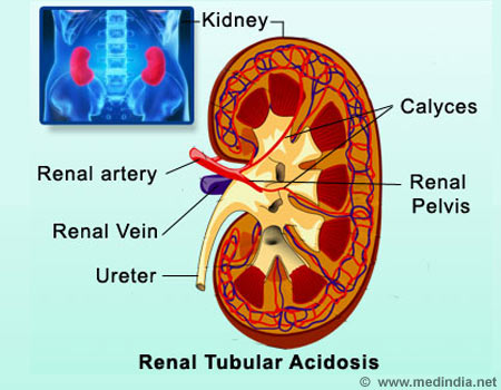 Renal Tubular Acidosis - Infographic