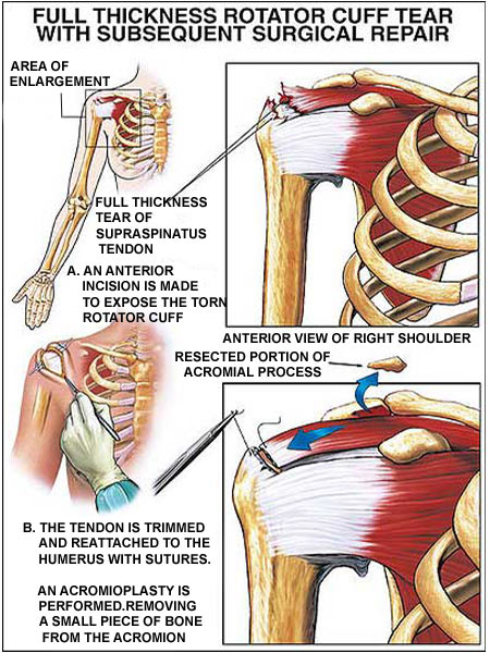 Rotator Cuff Injury - Infographic