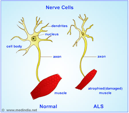 Amyotrophic Lateral Sclerosis - Infographic